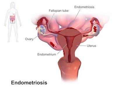 Blausen_0349_Endometriosis