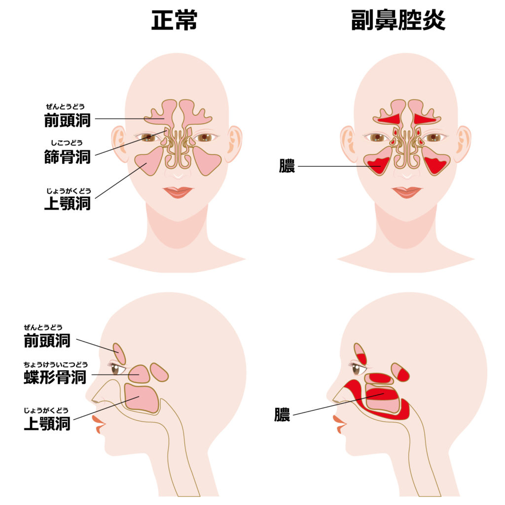 副鼻腔炎 蓄膿症 の漢方治療について 相模原タナココ漢方薬局 鍼灸接骨院