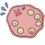 PCOS（多嚢胞卵巣症候群）と移植