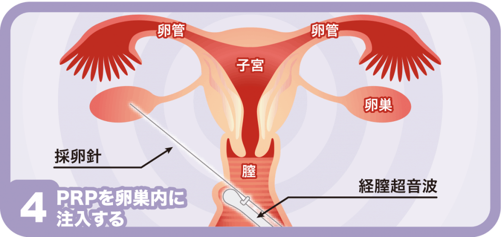 PRP、PFC-FD、卵巣、子宮内膜、妊活、不妊治療＜漢方,鍼灸,接骨,妊活,不妊,男性不妊,不育,メンタル不調,うつ,不眠,不安,腎不全,腎機能低下,アトピー,肌トラブル＞e