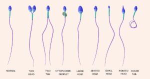 男性不妊、妊活、不妊治療、精子、精液検査＜漢方,鍼灸,接骨,妊活,不妊,男性不妊,不育,メンタル不調,うつ,不眠,不安,腎不全,腎機能低下,慢性腎臓病,CKD,アトピー,肌トラブル＞